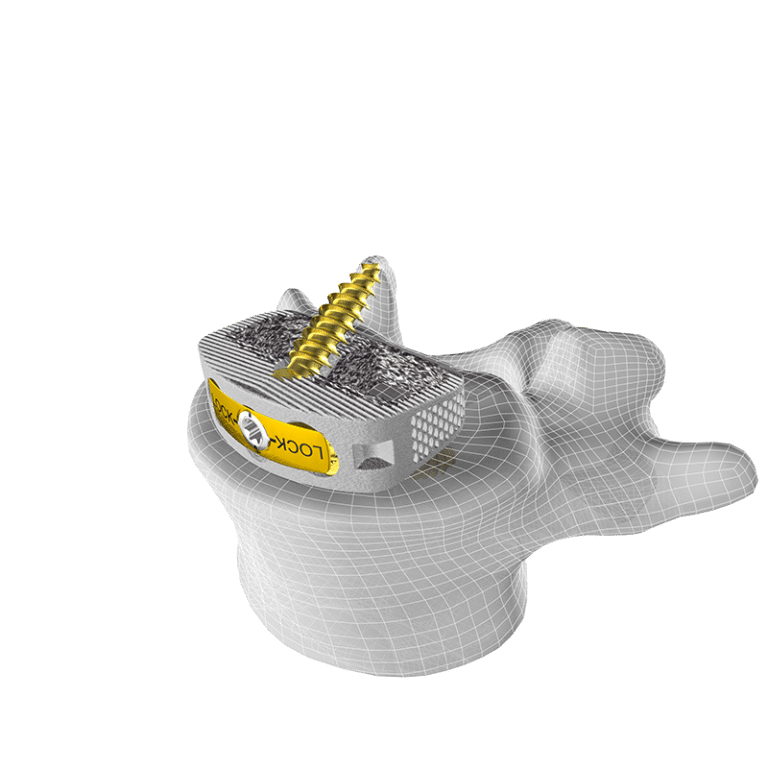 M3 Stand-alone ALIF System - CoreLink Surgical