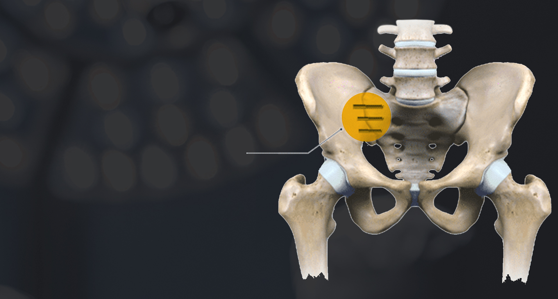 centene-positive-coverage-for-si-joint-fusion-corelink-surgical