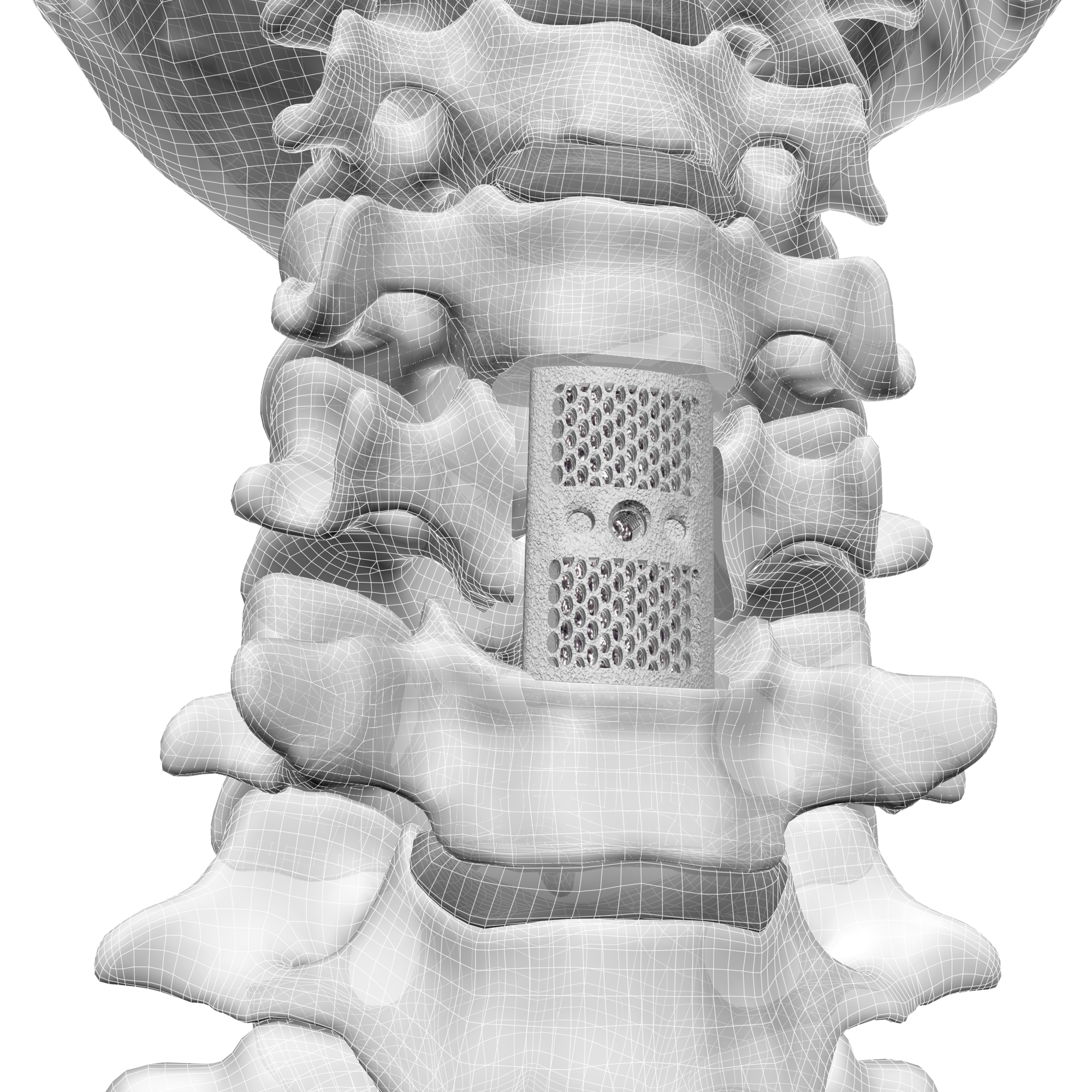 F3D Corpectomy VBR System - CoreLink Surgical